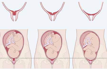 Cervix softening process
